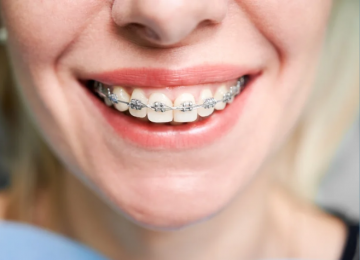 Por que os dentes podem entortar novamente após o uso de aparelho? Entenda o que dizem os especialistas