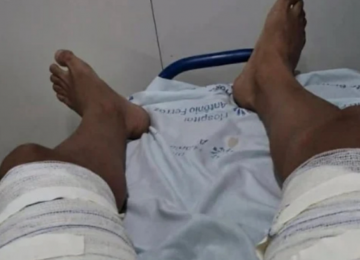 Mulher joga água fervente em ex-companheiro após término 
