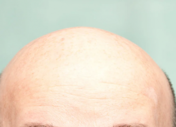 Novo medicamento em testes mostra potencial para estimular crescimento de cabelo