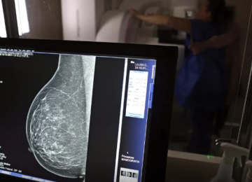 Ministério da Saúde passa a recomendar mamografia a partir dos 40 anos