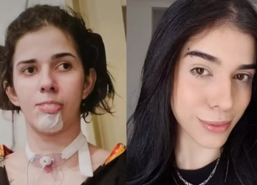 Mãe de jovem que ficou com sequelas após cheirar pimenta faz desabafo após três anos do caso