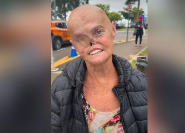 Idosa enfrenta 73 tumores e luta contra câncer há 28 anos