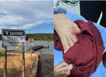 Criança perde parte do dedo após ataque de piranhas