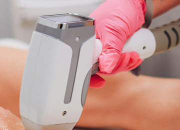 Mulher queimada em depilação a laser será indenizada