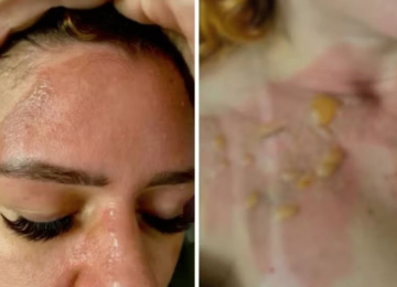 Influenciadora sofre queimaduras após panela de pressão explodir em Valparaíso de Goiás