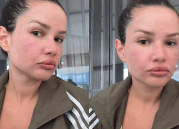 Juliette passa por procedimento estético com esperma de salmão e compartilha resultado nas redes