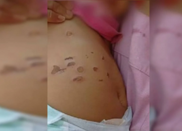 Bebê de 10 meses tem barriga e pernas queimada por cigarros 