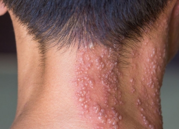 Vacina contra herpes-zóster pode reduzir em até 20% o risco de demência, aponta estudo internacional