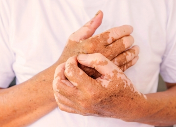 Vitiligo afeta mais de 1 milhão de brasileiros e impacta saúde emocional, alerta especialista