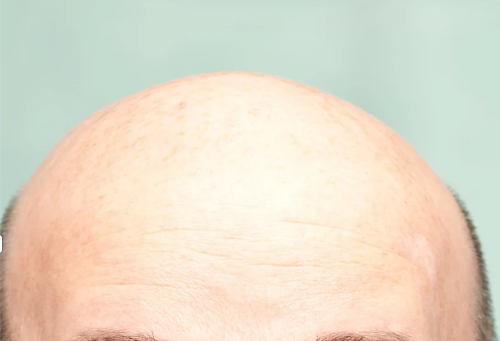 Novo medicamento em testes mostra potencial para estimular crescimento de cabelo