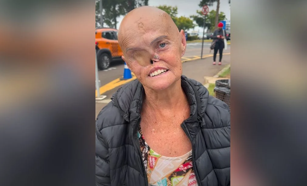 Idosa enfrenta 73 tumores e luta contra câncer há 28 anos