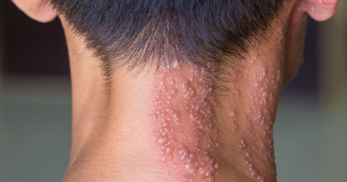 Vacina contra herpes-zóster pode reduzir em até 20% o risco de demência, aponta estudo internacional