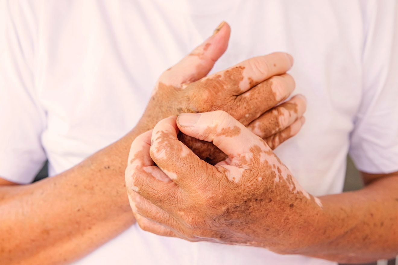 Vitiligo afeta mais de 1 milhão de brasileiros e impacta saúde emocional, alerta especialista