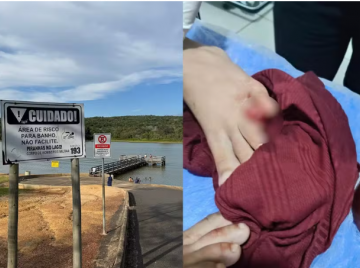 Criança perde parte do dedo após ataque de piranhas