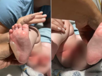 Banho em berçário termina em queimaduras em 29% de corpo de bebê, em Rio Verde