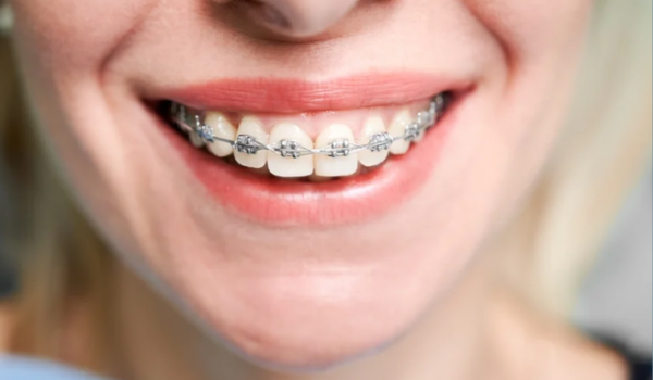 Por que os dentes podem entortar novamente após o uso de aparelho? Entenda o que dizem os especialistas