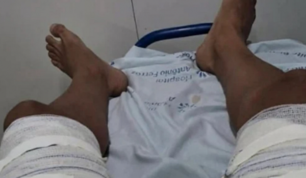 Mulher joga água fervente em ex-companheiro após término 