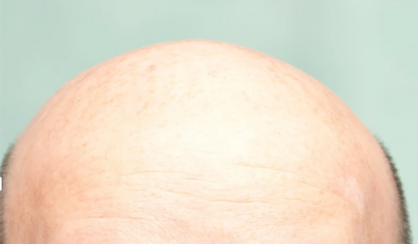 Novo medicamento em testes mostra potencial para estimular crescimento de cabelo