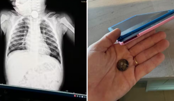 Mãe faz alerta após bebê de 1 ano engolir bateria de brinquedo em Goiás