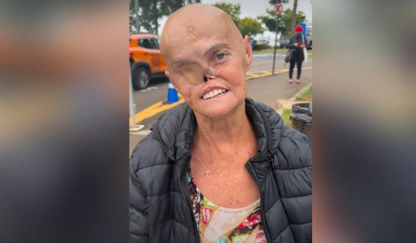 Idosa enfrenta 73 tumores e luta contra câncer há 28 anos
