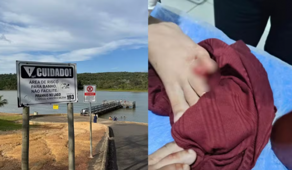 Criança perde parte do dedo após ataque de piranhas