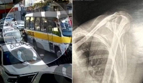 Mulher sofre 21 fraturas após ser prensada entre carro e ônibus escolar em Luziânia