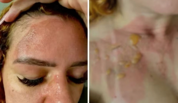 Influenciadora sofre queimaduras após panela de pressão explodir em Valparaíso de Goiás