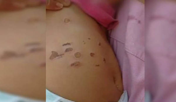 Bebê de 10 meses tem barriga e pernas queimada por cigarros 