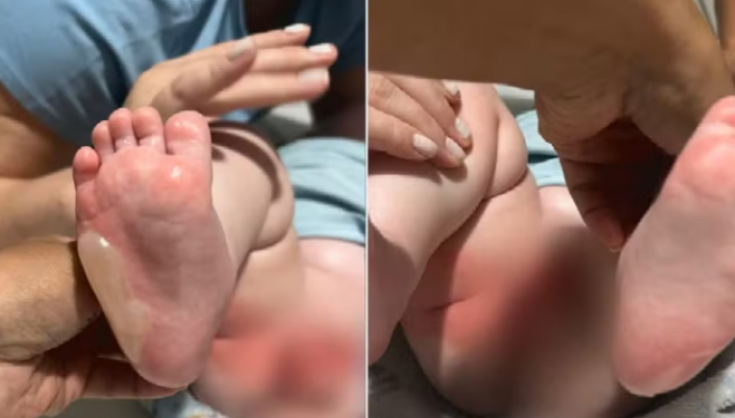 Banho em berçário termina em queimaduras em 29% de corpo de bebê, em Rio Verde