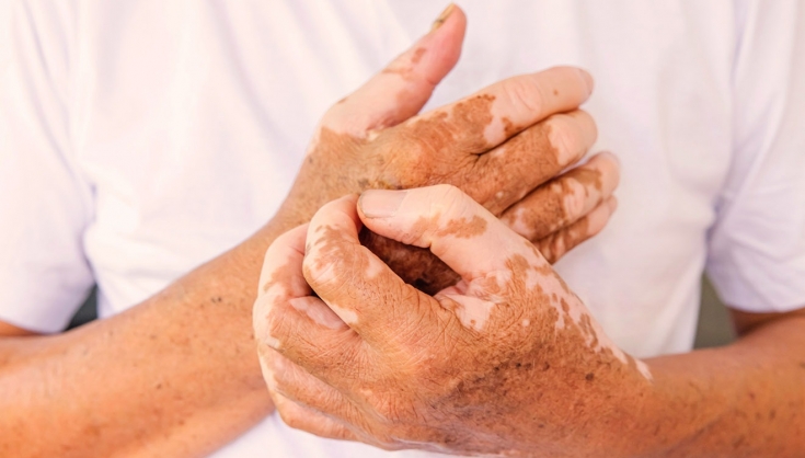 Vitiligo afeta mais de 1 milhão de brasileiros e impacta saúde emocional, alerta especialista